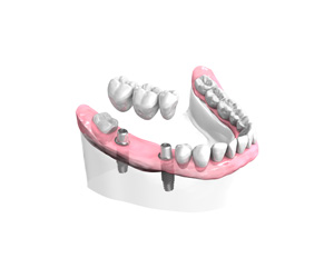 Remplacer plusieurs dents absentes ou abîmées à Persan