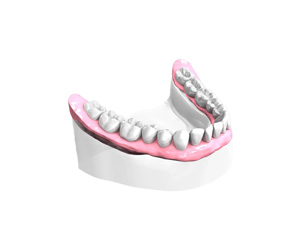 Remplacer plusieurs dents absentes ou abîmées à Persan